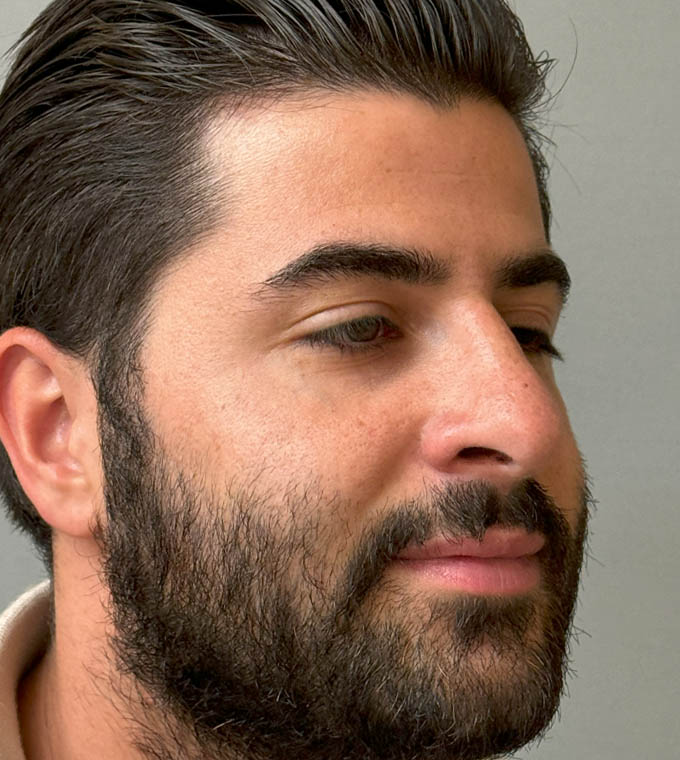 Rhinoplasty