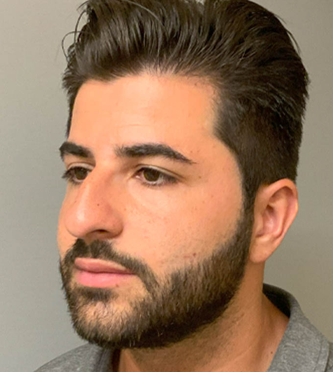 Rhinoplasty