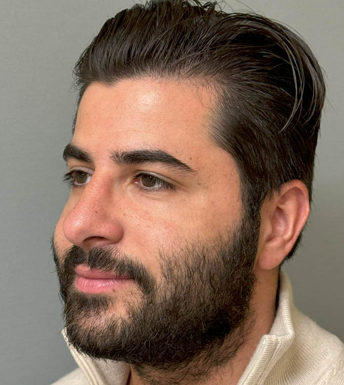 Rhinoplasty