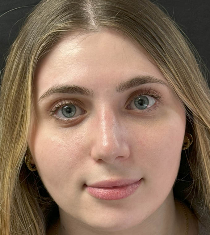 Rhinoplasty
