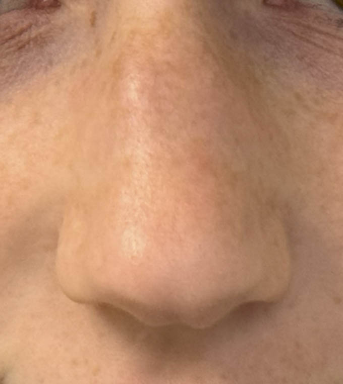Rhinoplasty