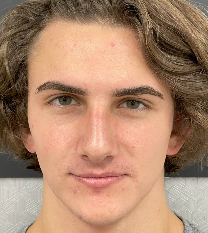 Rhinoplasty