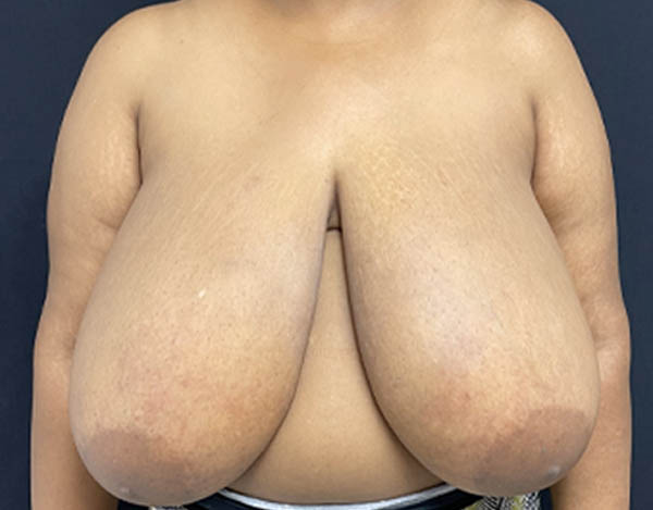 Breast Reduction