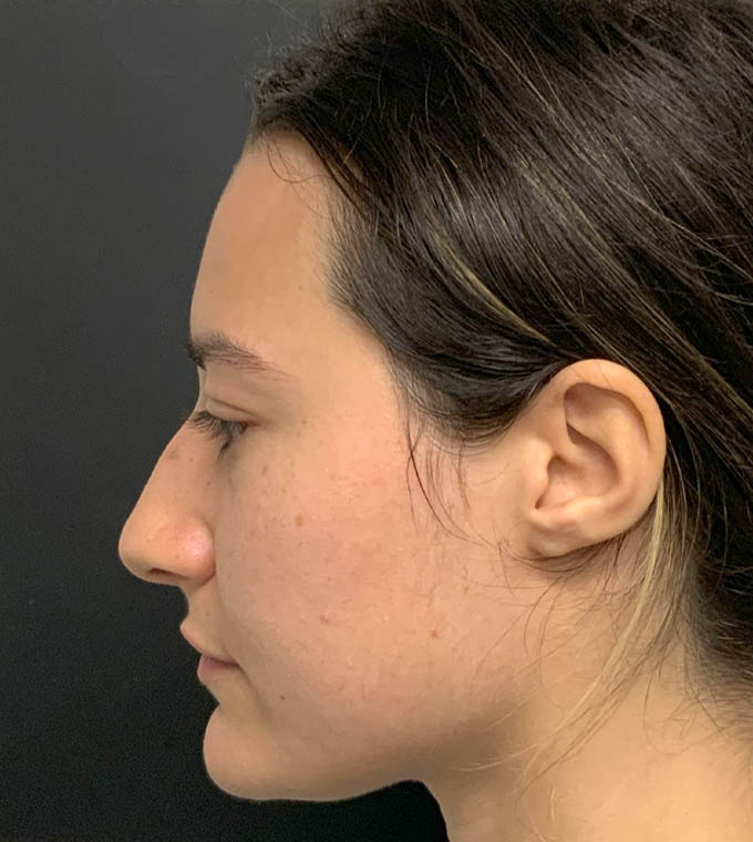 Rhinoplasty