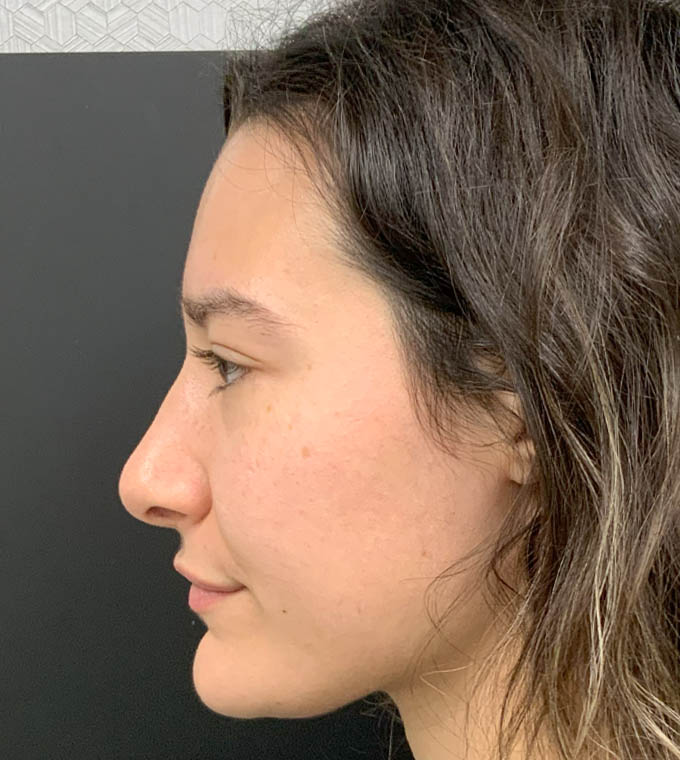 Rhinoplasty