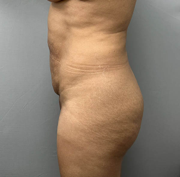 Tummy Tuck