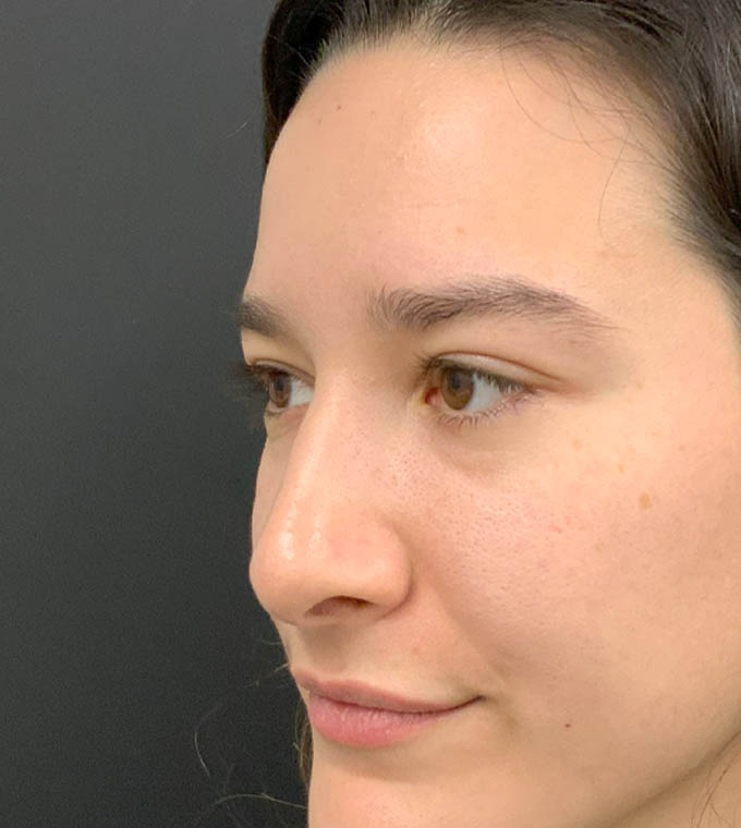 Rhinoplasty