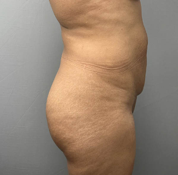 Tummy Tuck