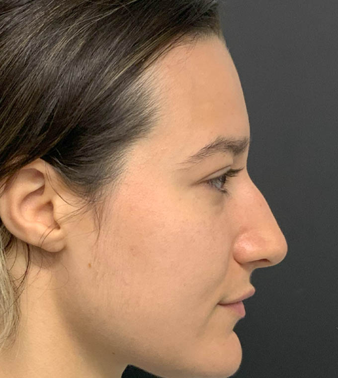 Rhinoplasty