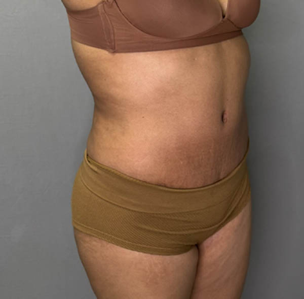 Tummy Tuck