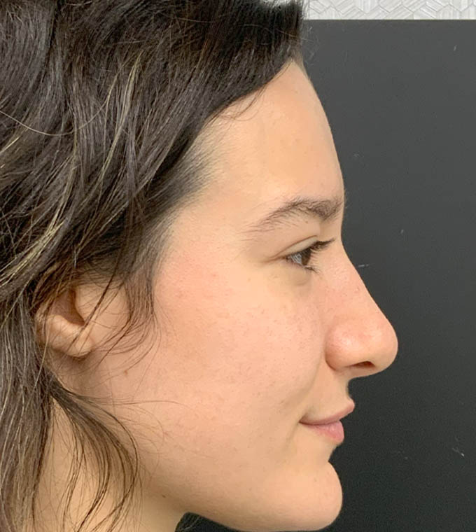 Rhinoplasty