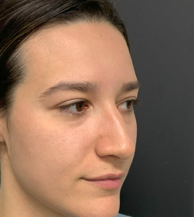 Rhinoplasty