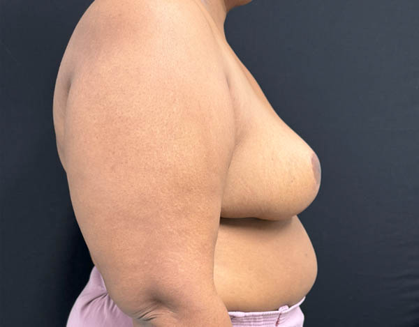 Breast Reduction
