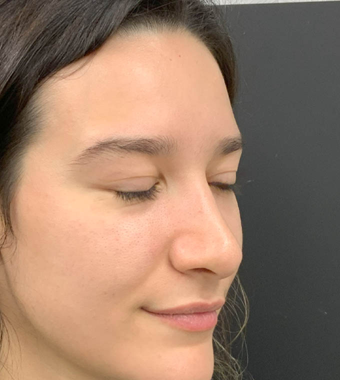Rhinoplasty