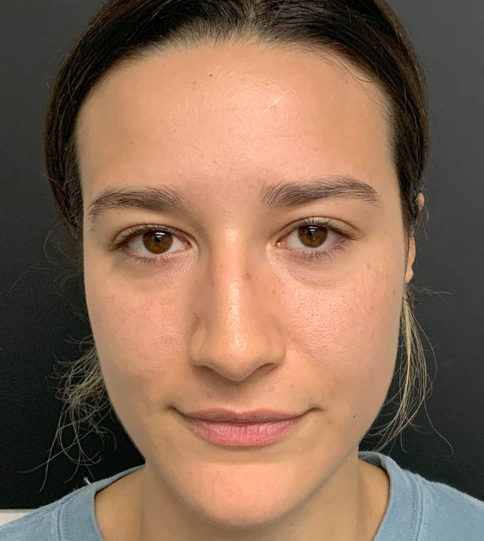 Rhinoplasty