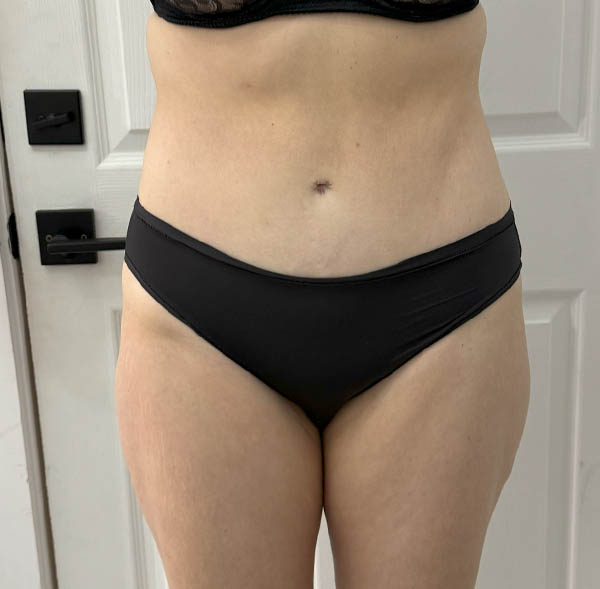 Tummy Tuck