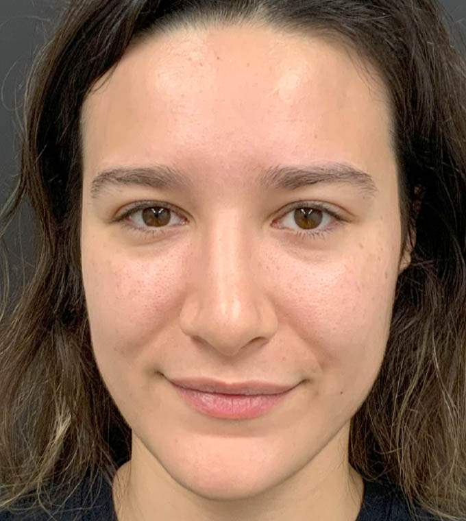 Rhinoplasty