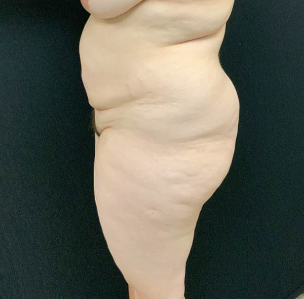 Tummy Tuck