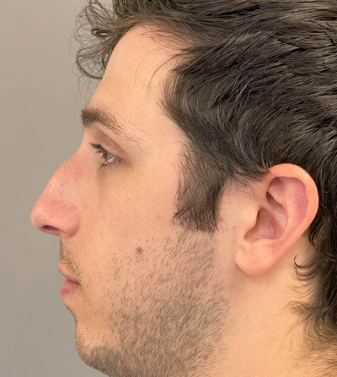 Rhinoplasty