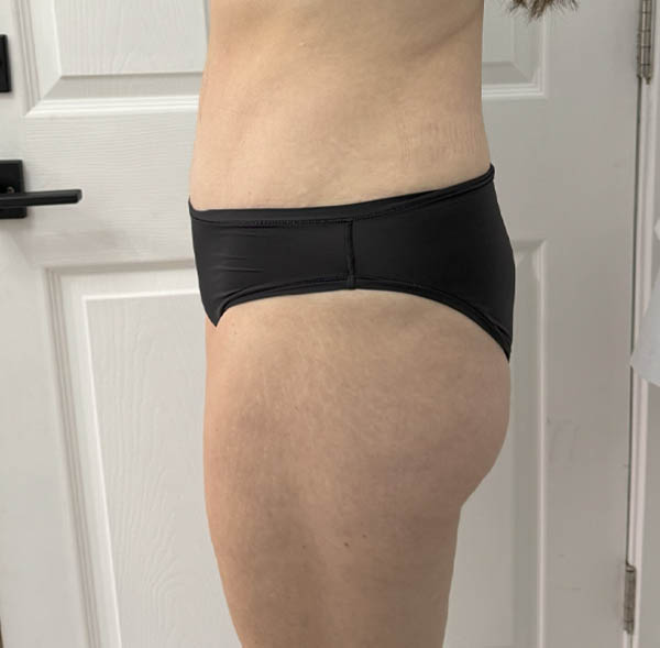 Tummy Tuck