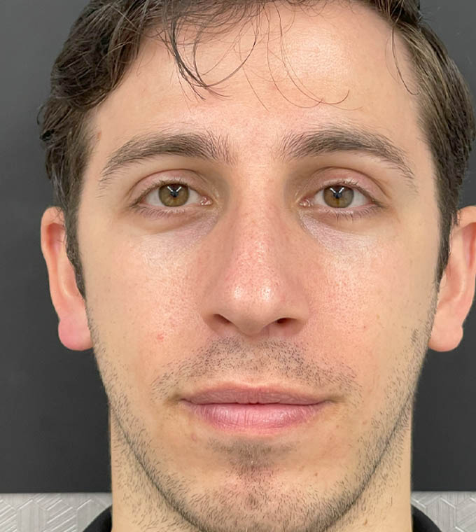 Rhinoplasty
