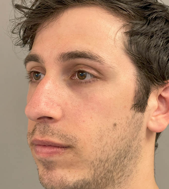 Rhinoplasty