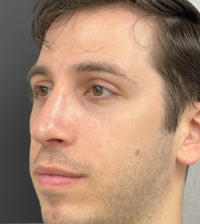 Rhinoplasty