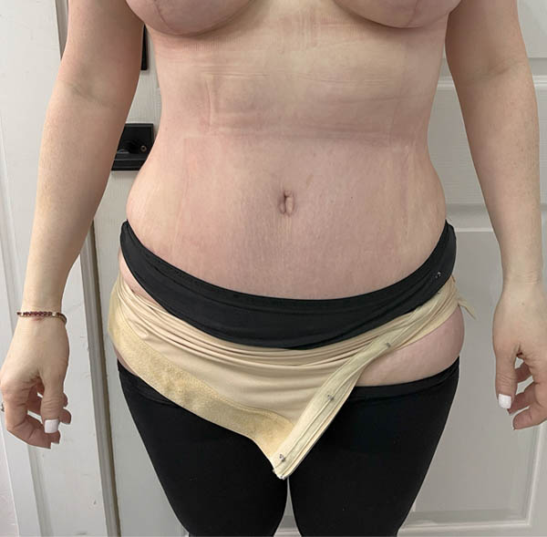 Tummy Tuck
