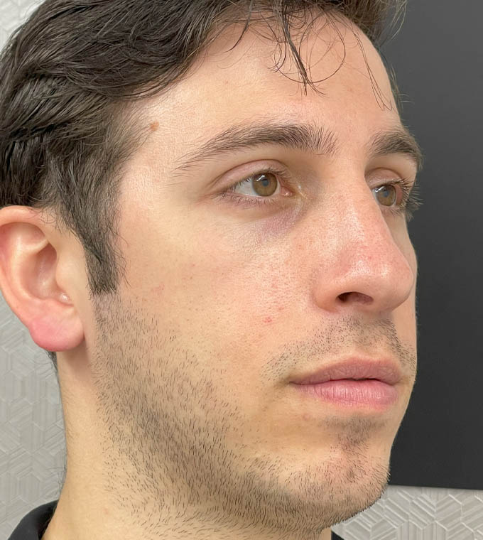 Rhinoplasty