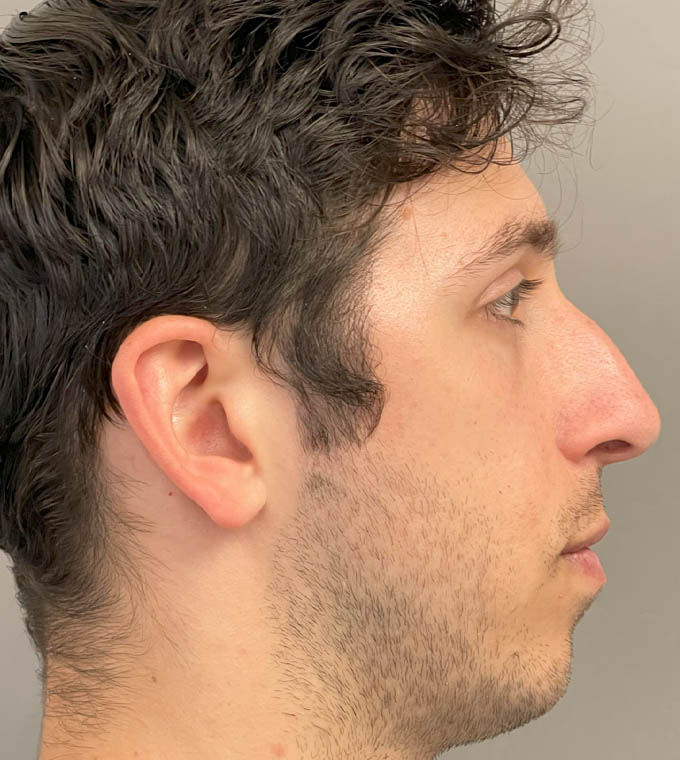 Rhinoplasty
