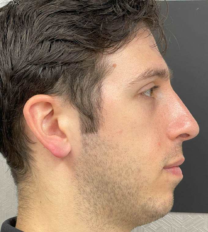 Rhinoplasty