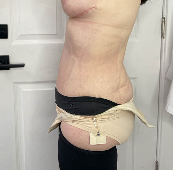 Tummy Tuck