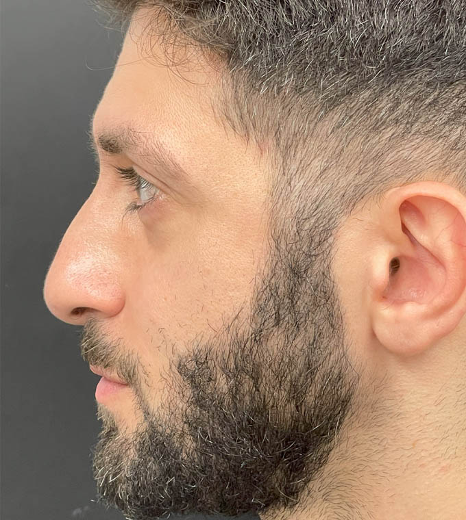 Rhinoplasty