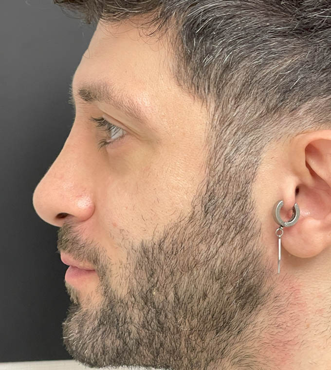 Rhinoplasty