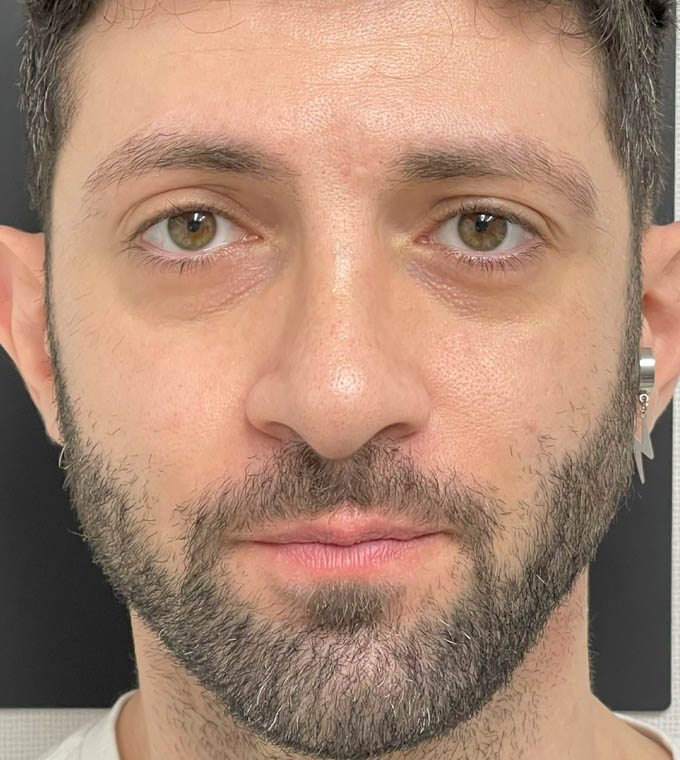 Rhinoplasty