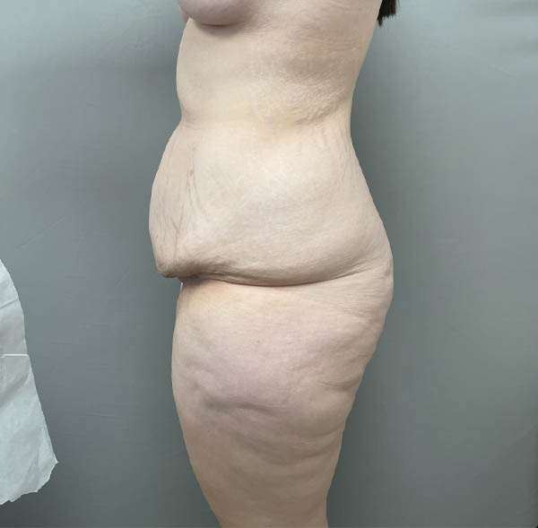 Tummy Tuck