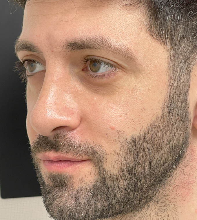 Rhinoplasty