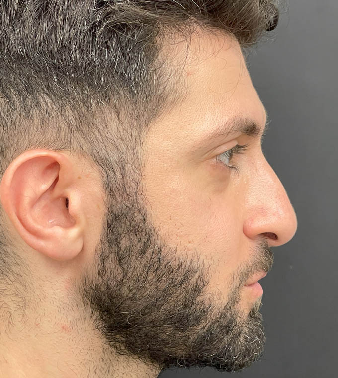 Rhinoplasty