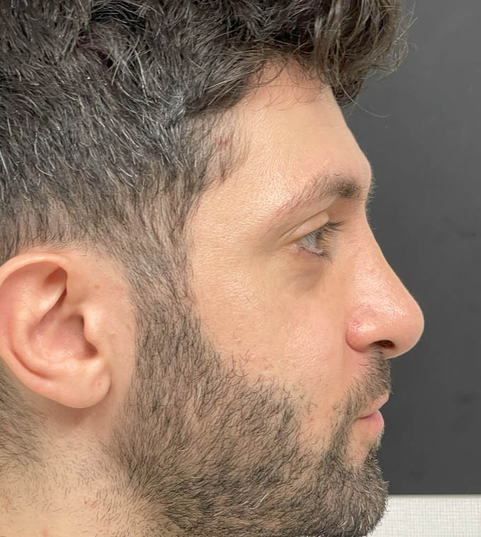 Rhinoplasty
