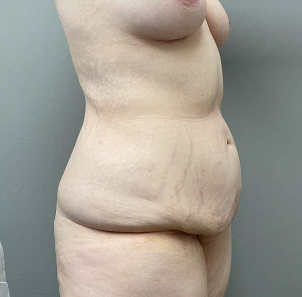 Tummy Tuck