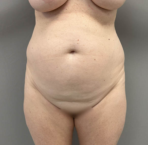 Tummy Tuck