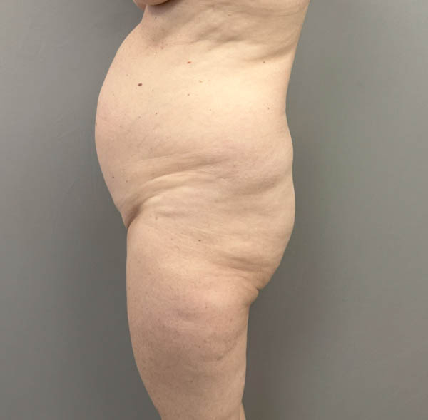 Tummy Tuck