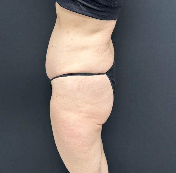 Tummy Tuck