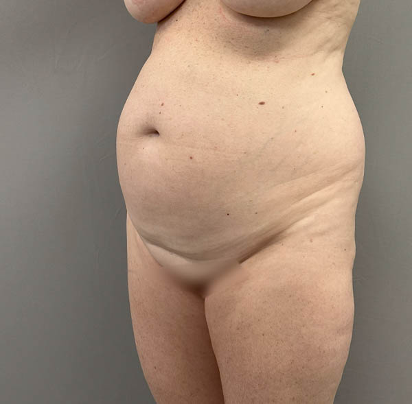 Tummy Tuck