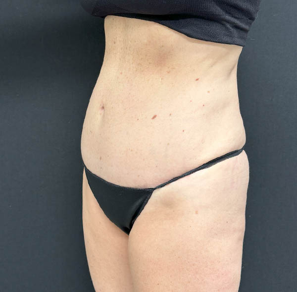 Tummy Tuck