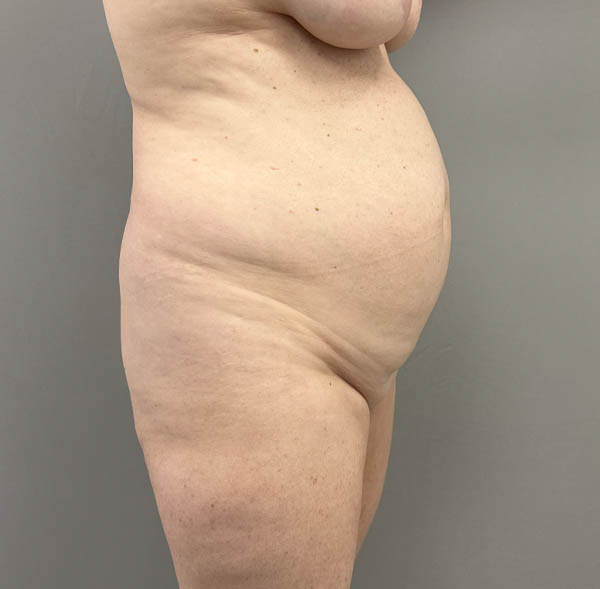 Tummy Tuck