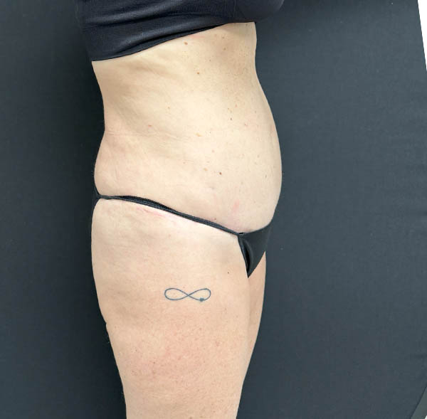 Tummy Tuck
