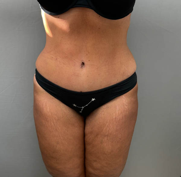 Tummy Tuck