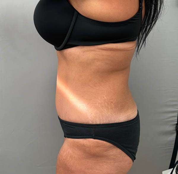 Tummy Tuck