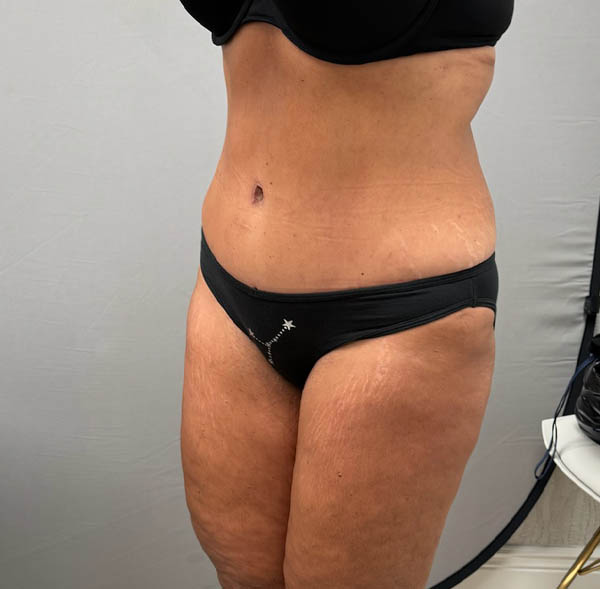 Tummy Tuck